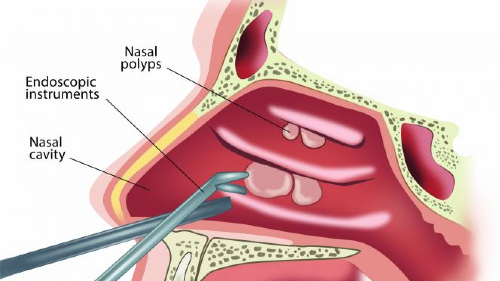 What Are Nasal Polyps Dr I Tyagi Ent Surgeon Lucknow